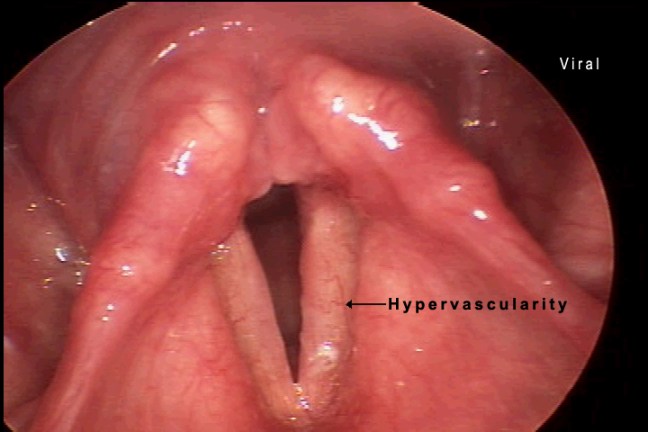 7viralaryngitis.jpg